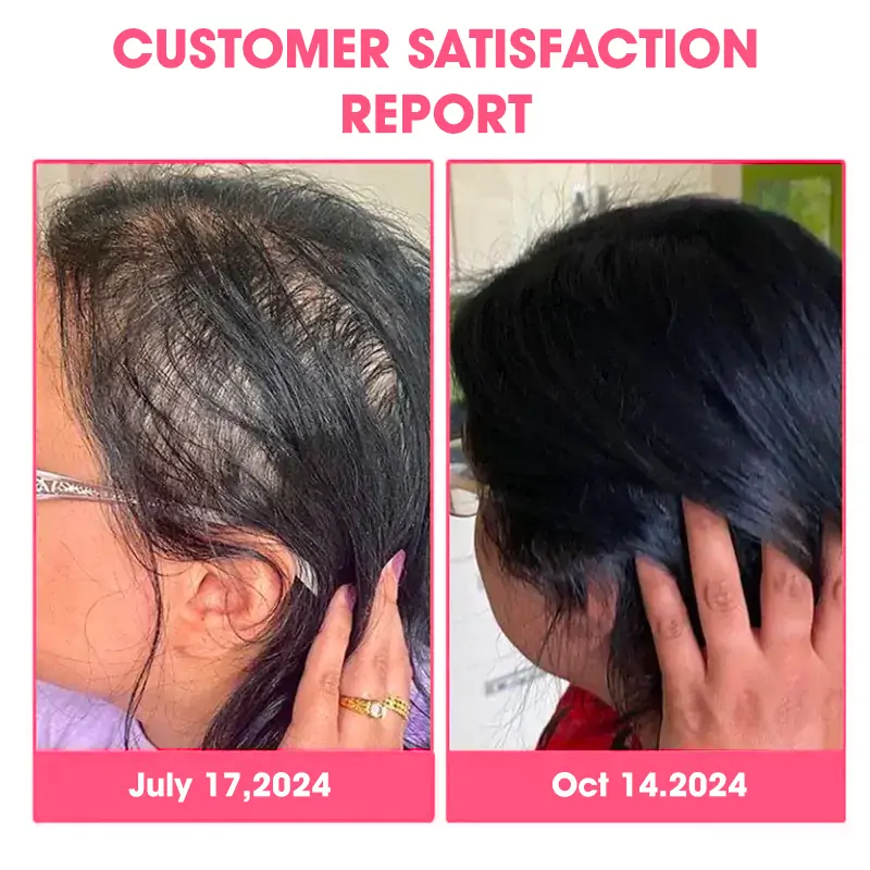 ✨️DeeVoo™ Luxe Bee venom Scalp Treatment HairGrᴏᴡth Hair Spray(Hurry, 80% OFF - Only 30 minutes left 🫧)