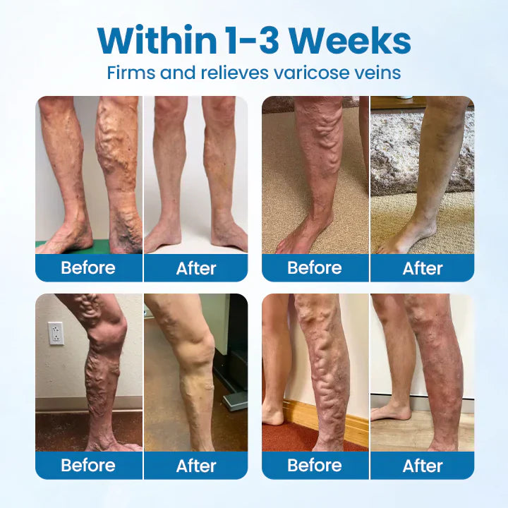 🌈🌈Ourlyard® VeinGuard Herbal Spray-✅ Clinically proven to eliminate varicose veins in just 7 days! (🔥Limited Time 80% OFF🔥)