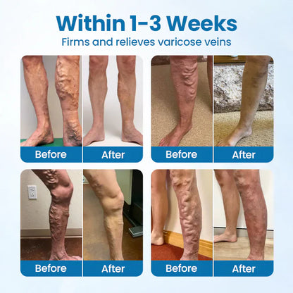 🌈🌈Ourlyard® VeinGuard Herbal Spray-✅ Clinically proven to eliminate varicose veins in just 7 days! (🔥Limited Time 80% OFF🔥)