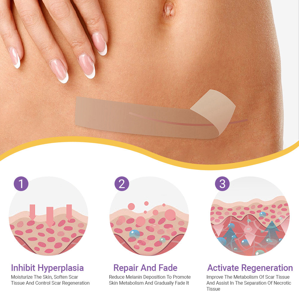 ✅Official Store |Ourlyard® Hyaluronic Acid Nano Microneedle Repair Tape🏥(Treatment of old and new scars, reduction of surgical scars, stretch marks, keloids, acne, burns, warts, dermatomes and varicose veins)