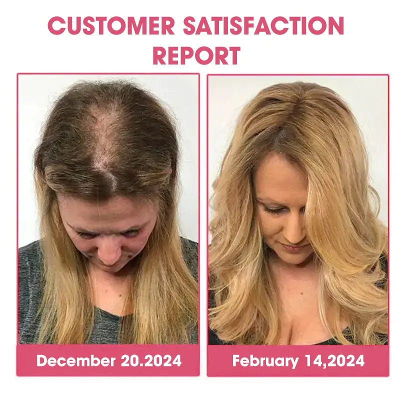 ✨️DeeVoo™   Luxe Bee venom Scalp Treatment HairGrᴏᴡth Hair Spray(Hurry, 80% OFF - Only 30 minutes left 🫧)